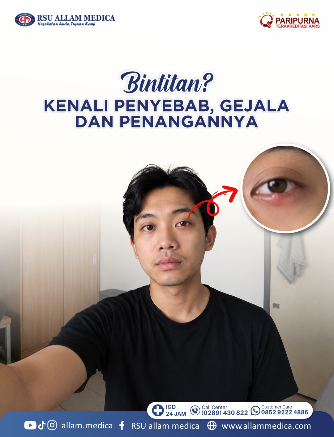 Bintitan? Kenali Penyebab, Gejala, dan Cara Mengatasinya